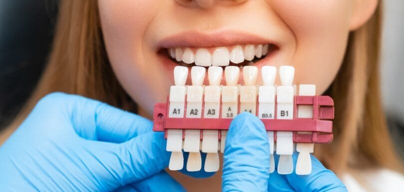 A dental professional compares a patient's teeth shade to a dental shade guide during a teeth whitening procedure, highlighting effective dental care practices.